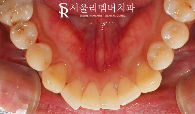 15분이면 신림 치과 스케일링 착색 제거로 까맣고 누런 치석 없앨 수 있습니다. 관련 이미지 5