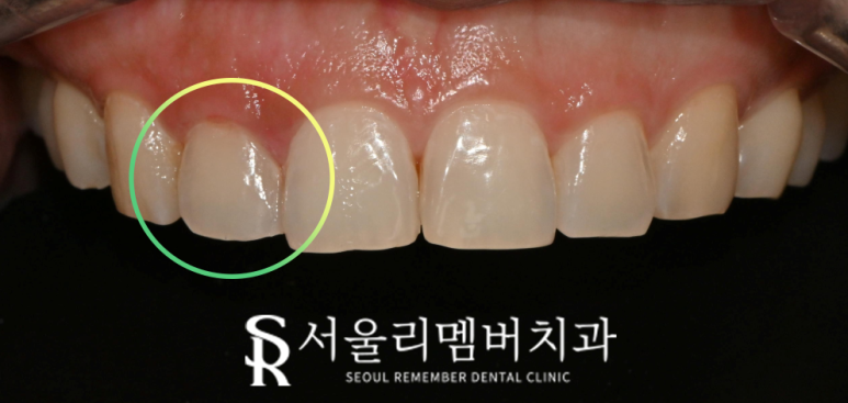 상도동 치과 충치나 치아 깨짐 해결 원탑 레진의 한계는? 주의 사항 및 재치료 방법 관련 이미지 2