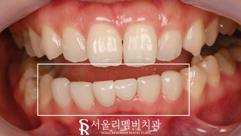 사당 치과 아래 앞니 만기 잔존 유치 크라운과 리얼네이트 동시에 심미 보철 치료 관련 이미지 6