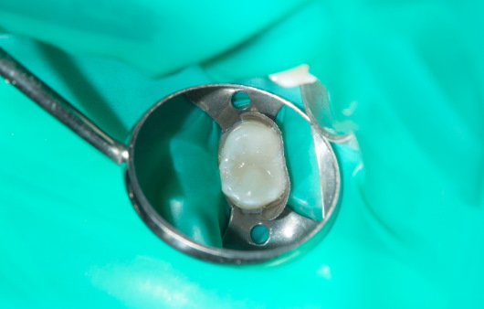 낙성대역 치과 신경치료가 필요한 경우는?! 관련 이미지 3