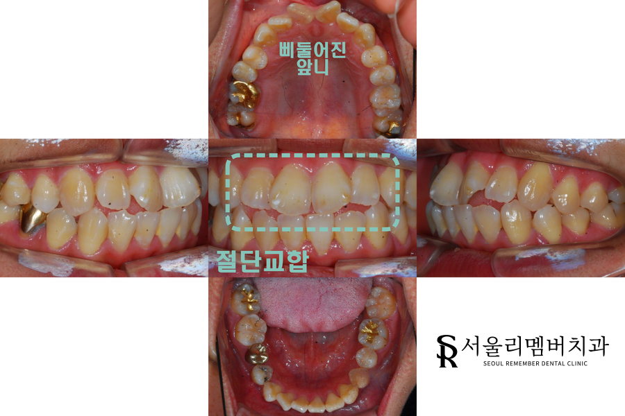 절단 교합 (edge to edge)이 나타난 치아, 봉천동 치과 인비절라인 교정 증례 관련 이미지 1