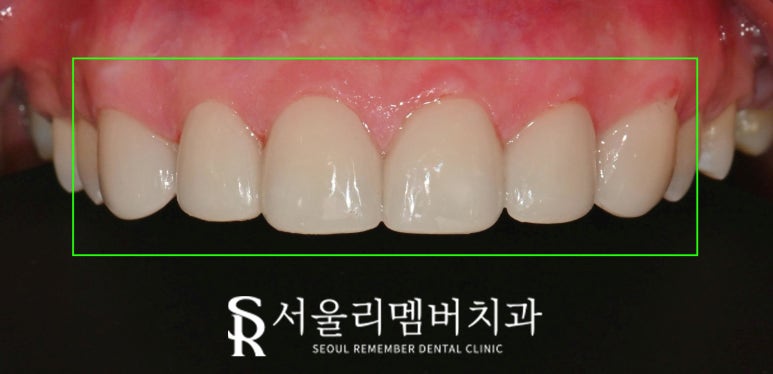 앞니 치료, 이제는 자연스러움이 답이다! 봉천동 치과 진짜 같은 라미네이트 "리얼네이트" 관련 이미지 4