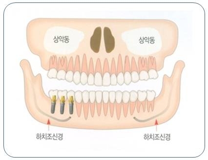 신대방 치과 고난도 전악 임플란트 수술 가능 관련 이미지 5