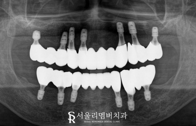 상도동 치과 위아래 다수의 치아 상실, 원가이드를 이용한 디지털 임플란트 로 상하악 전체 재건 가능 관련 이미지 5