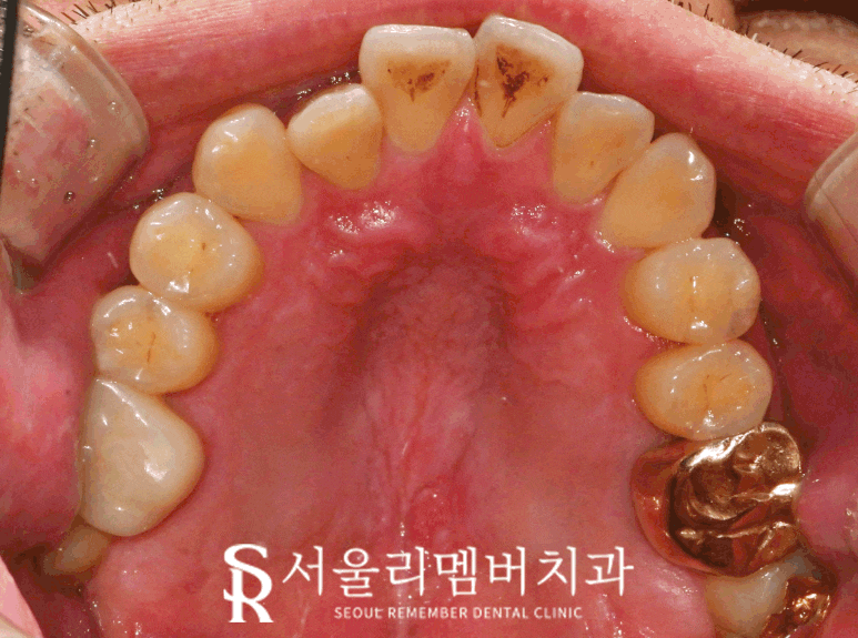 사당 치과 치석 및 착색 제거 연 1회 보험 스케일링 비용 가격 통증 시간 식사 음주 관련 이미지 2