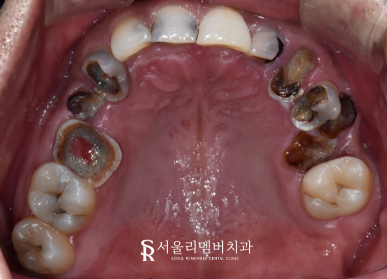 임플란트와 치아교정, 동시에 치료받을 수 있을까요? 남성역 서울 리멤버 치과 관련 이미지 2