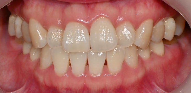 선천적 영구치 결손으로 남아있는 만기 잔존 유치, 서울대입구역 교정 치과 에서 투명 인비절라인 & 임플란트 케이스 관련 이미지 1