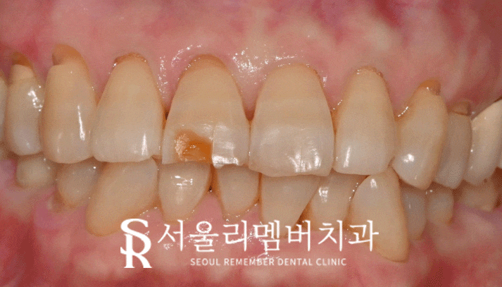 봉천역 치과 깨진 앞니와 치경부 마모, 레진 당일 수복 증례 관련 이미지 4