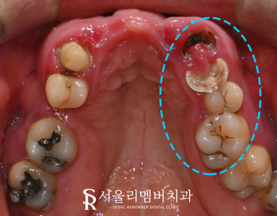 때늦은 치료, 임플란트와 크라운으로 바로잡는 서울대입구역 치과 관련 이미지 3