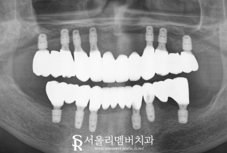 신대방 치과 고난도 전악 임플란트 수술 가능 관련 이미지 6