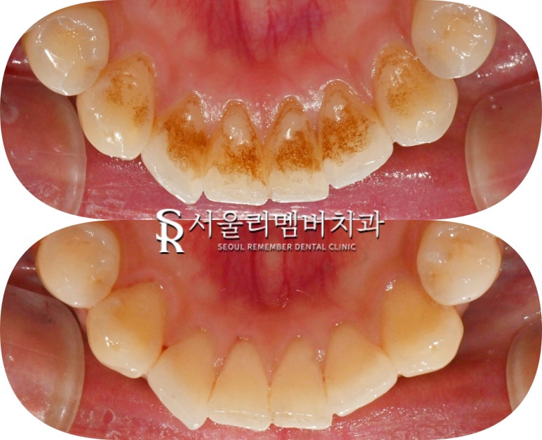 15분이면 신림 치과 스케일링 착색 제거로 까맣고 누런 치석 없앨 수 있습니다. 관련 이미지 6