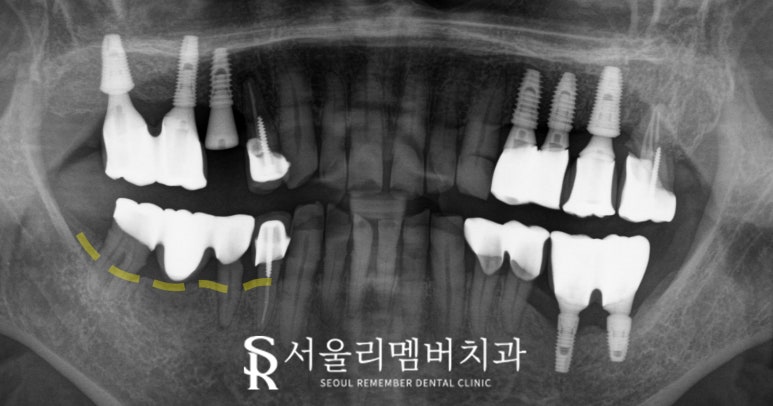 임플란트 및 크라운 으로 구강 환경 개선하는 방법 - 서울대입구역 치과 관련 이미지 3