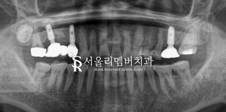 서울대입구역 치과 음식 찌꺼기가 계속 껴요. 관련 이미지 4