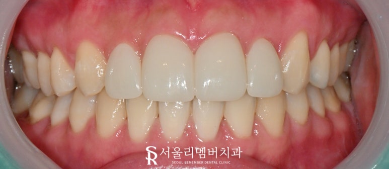 치아 크기 작은 왜소 측절치, 봉천동 치과 전치부 라미네이트로 자연치 삭제 없이 리얼하게 개선하는 방법 관련 이미지 4