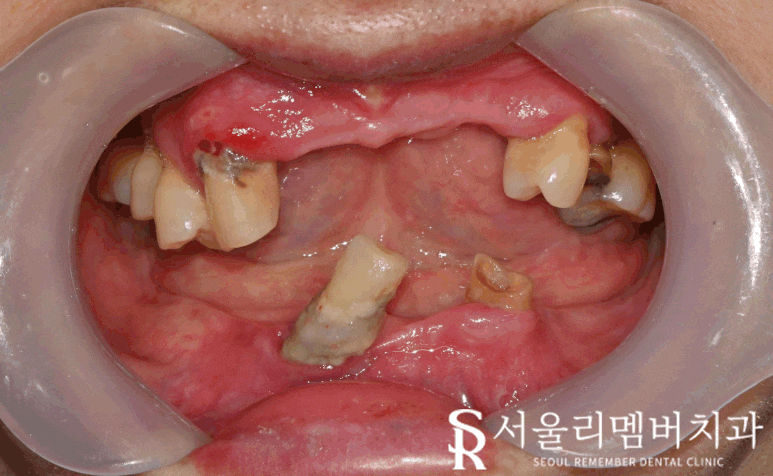 치주염으로 균형이 깨져버린 구강, 신대방 치과 에서 전체 임플란트 수술 증례 관련 이미지 3