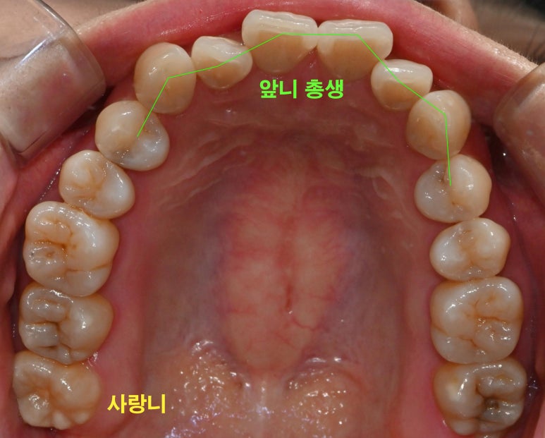 선천적 영구치 결손으로 남아있는 만기 잔존 유치, 서울대입구역 교정 치과 에서 투명 인비절라인 & 임플란트 케이스 관련 이미지 2