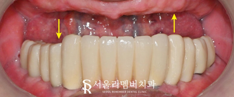 임플란트로 구강환경개선 신림역 치과 에서 깔끔하게 치료한 케이스 관련 이미지 1