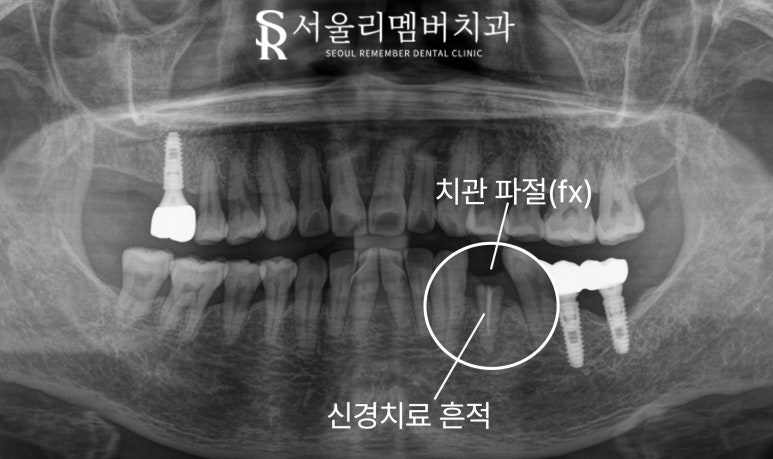 보라매 치과 신경치료 치아 부러짐, 당일 발치 즉시 임플란트 동시 식립(Simple case) 관련 이미지 1