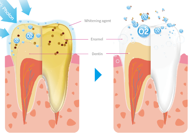 "변색 원인, 미백 방법, 주의사항까지" 서울대입구역 치과 에서 알려주는 하얀 치아를 위한 모든 것 관련 이미지 2