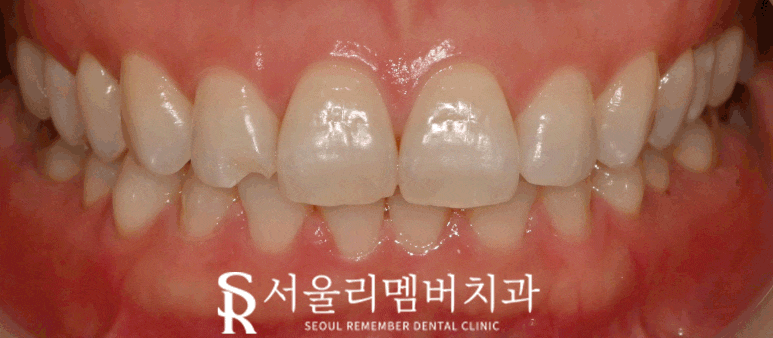 "빠각" 소리와 함께 앞니 절단연 파절 되었다면? 서울대입구역 치과 레진 당일 치료 관련 이미지 2
