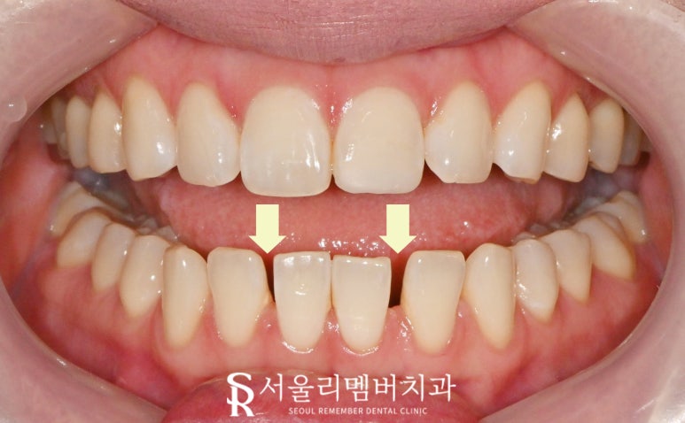 하악 전치 벌어진 공간 스페이스 해소를 위한 아래 앞니 6전치 리얼네이트 라미네이트 케이스 관련 이미지 1