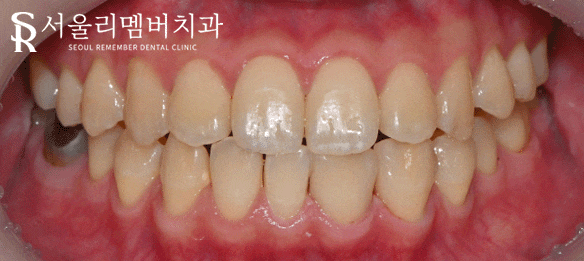 은천동 치과 치아 사이 벌어짐, 당일 치료 가능할까요? 관련 이미지 3