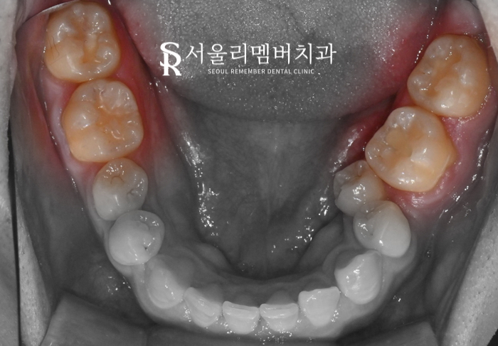 어금니에 까만 점이 있어요.. 충치치료를 받아야 되나요? 봉천역 치과 관련 이미지 4