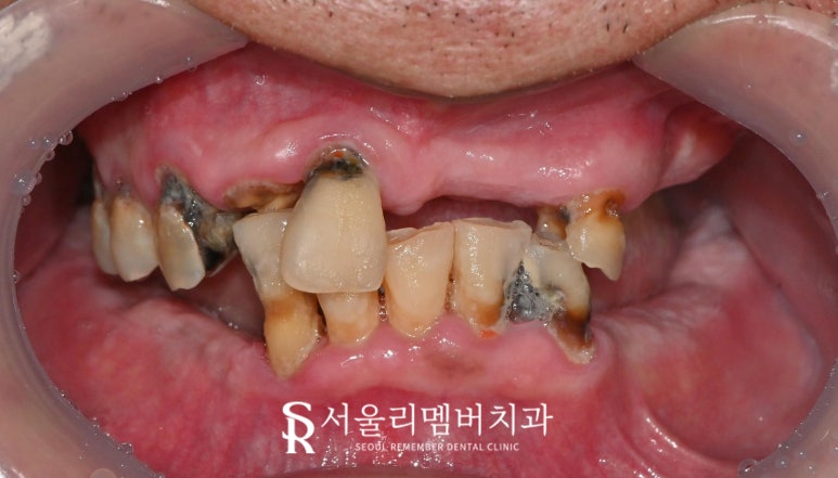 서울대입구역 치과 에서 안전하고 신속 정확하게 발치 후 전악 임플란트 식립한 케이스 관련 이미지 1