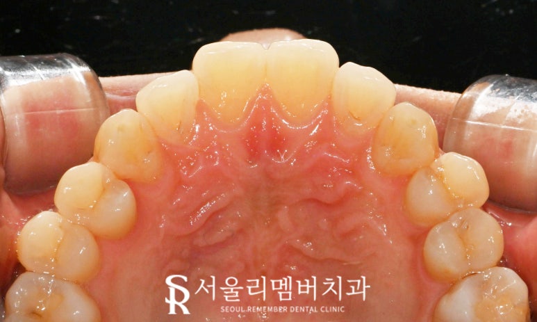 15분이면 신림 치과 스케일링 착색 제거로 까맣고 누런 치석 없앨 수 있습니다. 관련 이미지 4
