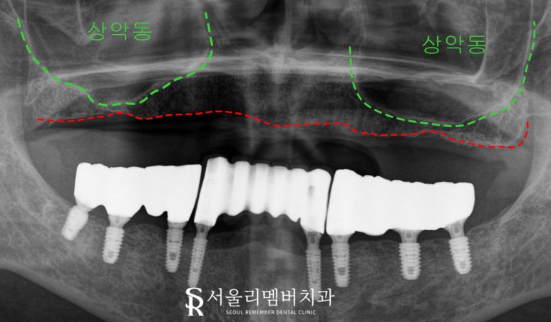 임플란트로 구강환경개선 신림역 치과 에서 깔끔하게 치료한 케이스 관련 이미지 3
