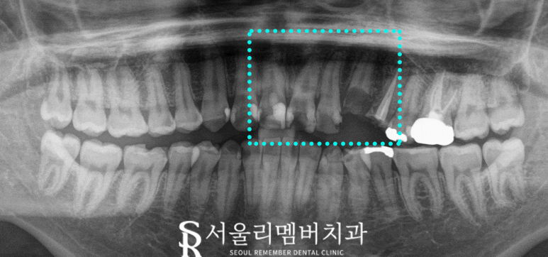 신대방 치과 "처음에는 작은 충치, 나중에는 치아 발치?" 앞니 임플란트 및 신경치료 후기 관련 이미지 2