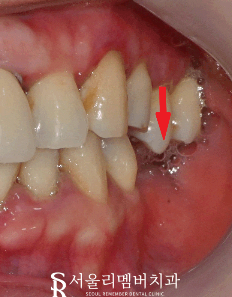 낙성대 치과 "어금니가 없어요." 가이드 임플란트와 신경치료 과정 관련 이미지 2