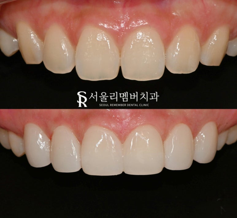 서울대입구역 치과 결혼 앞둔 예비 신부 주목! 누런 앞니, 모양 마음에 들지 않는다면 무삭제 라미네이트로 해결 관련 이미지 3