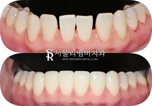 하악 전치 벌어진 공간 스페이스 해소를 위한 아래 앞니 6전치 리얼네이트 라미네이트 케이스 관련 이미지 5