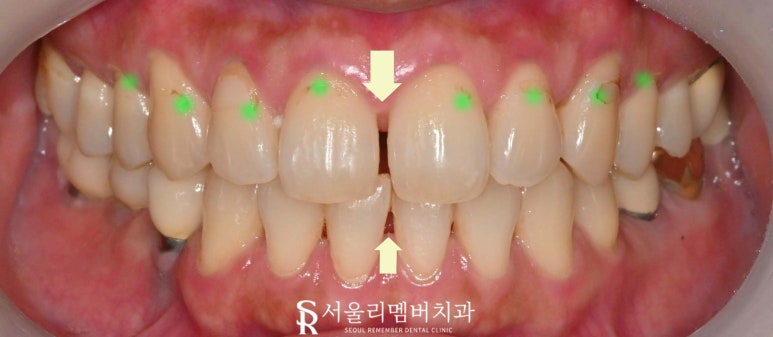 Improving Spaces Between the Front Teeth and Dark Staining from Discolored Resin at the Same Time: Anterior Laminate Veneers and Realnate at Seoul National University Entrance Station Dental Clinic image 1