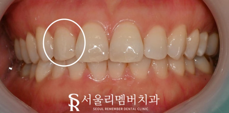 "빠각" 소리와 함께 앞니 절단연 파절 되었다면? 서울대입구역 치과 레진 당일 치료 관련 이미지 4
