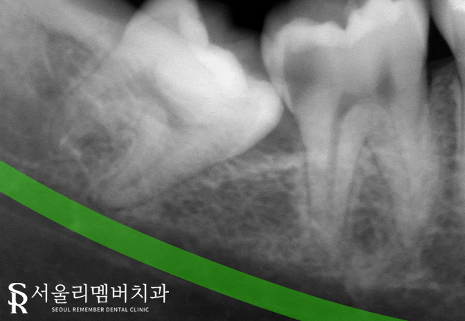 관악구 치과 원인을 알 수 없는 치통, 매복되어 있는 사랑니 때문? 관련 이미지 2