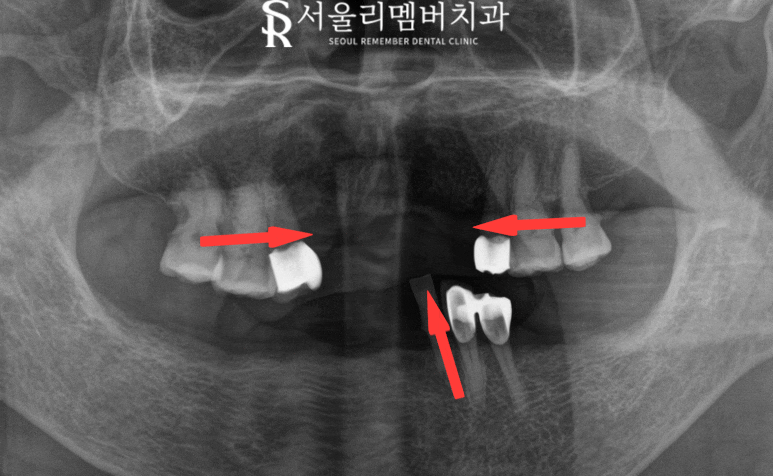 신림역 치과 "틀니는 쓰기 싫어요." 전체 임플란트 식립 후기 관련 이미지 3