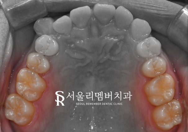 어금니에 까만 점이 있어요.. 충치치료를 받아야 되나요? 봉천역 치과 관련 이미지 3