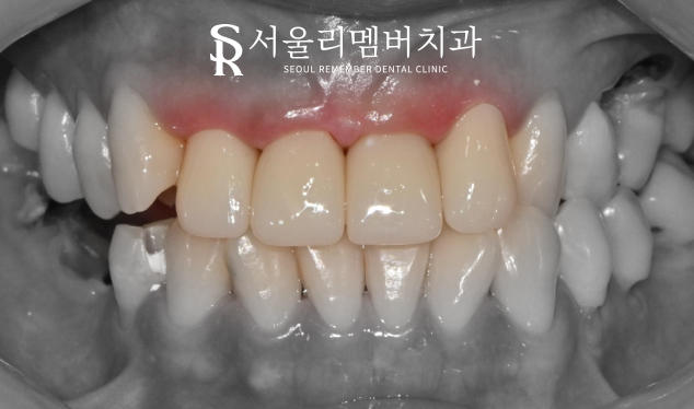 전치부 신경치료, 크라운까지 확실하게 씌워야 되는 이유는? 서울대입구역치과 관련 이미지 4