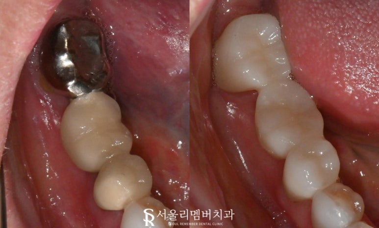 서울대입구역 치과 에서 오래된 어금니 브릿지 지르코니아 크라운 으로 교체해서 심미성 되찾아드렸습니다. 관련 이미지 5