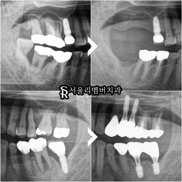 잇몸뼈 녹아버린 치아, 발치 후 그다음은? 사당역 치과 임플란트 관련 이미지 5