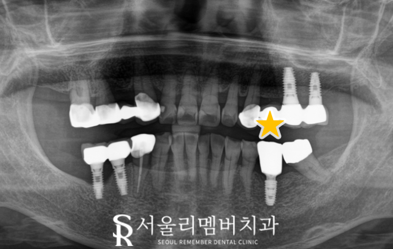 신림역 치과 오스템 BA 임플란트 당일 수술로 빠져버린 어금니 회복 관련 이미지 4