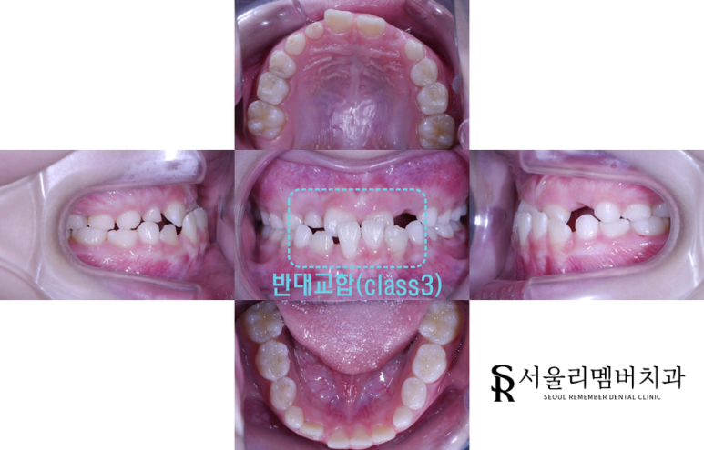 반대교합 전 관련 이미지 1