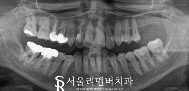 앞니 충치, 살릴 수 없는 상태라면? 서울대입구 임플란트 치과에서 해결 관련 이미지 3