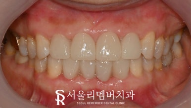 Restore a Natural, Even Smile with No-Prep Realnate! Laminate Veneers for Front Teeth at a Seoul National University Entrance Station Dental Clinic image 6