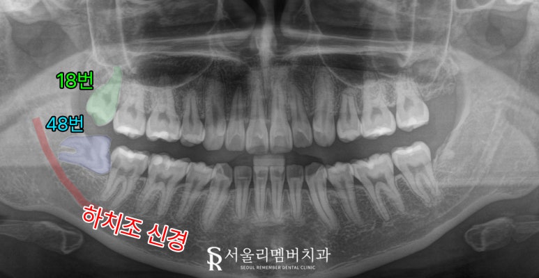 사랑니 주변 잇몸이 자꾸 붓고 아프다면? 서울대입구역 치과 발치 꼭 해야 될까? 관련 이미지 2
