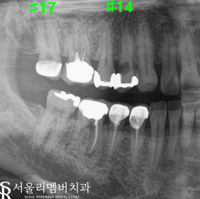 치아 곳곳에서 생긴 문제, 사당 치과 임플란트 및 크라운 치료 관련 이미지 4