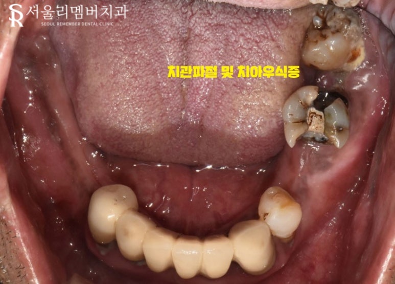 오래된 보철을 방치하면 결국 임플란트 식립밖에 남지 않게 됩니다! 봉천역 리멤버 치과 관련 이미지 4