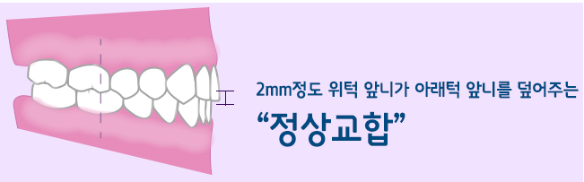신림 치과 깨지고 길이 안 맞는 앞니 부러진 부분만 레진으로 간단하게 당일 치료 관련 이미지 2